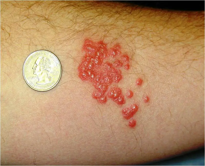 Bed Bug Bite Signs Symptoms Pictures And Treatment