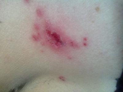 Bedbugs can leave horrible fluid filled blisters!