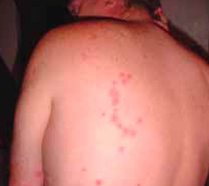 bed bug bite pattern