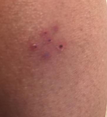 Bug/spider bite