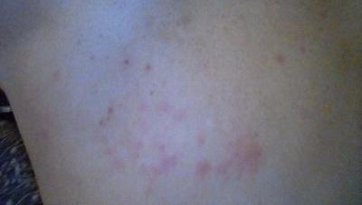 Bed Bug Bites